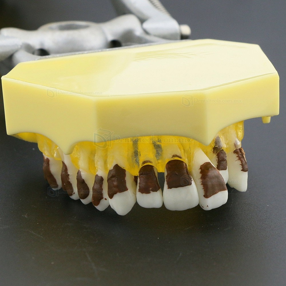 Modelo dental de enfermedad periodontal con enc&iacute;as inflamadas y c&aacute;lculo dental 4003