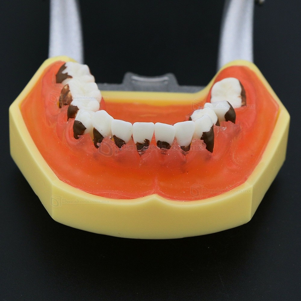 Modelo dental de enfermedad periodontal con enc&iacute;as inflamadas y c&aacute;lculo dental 4003