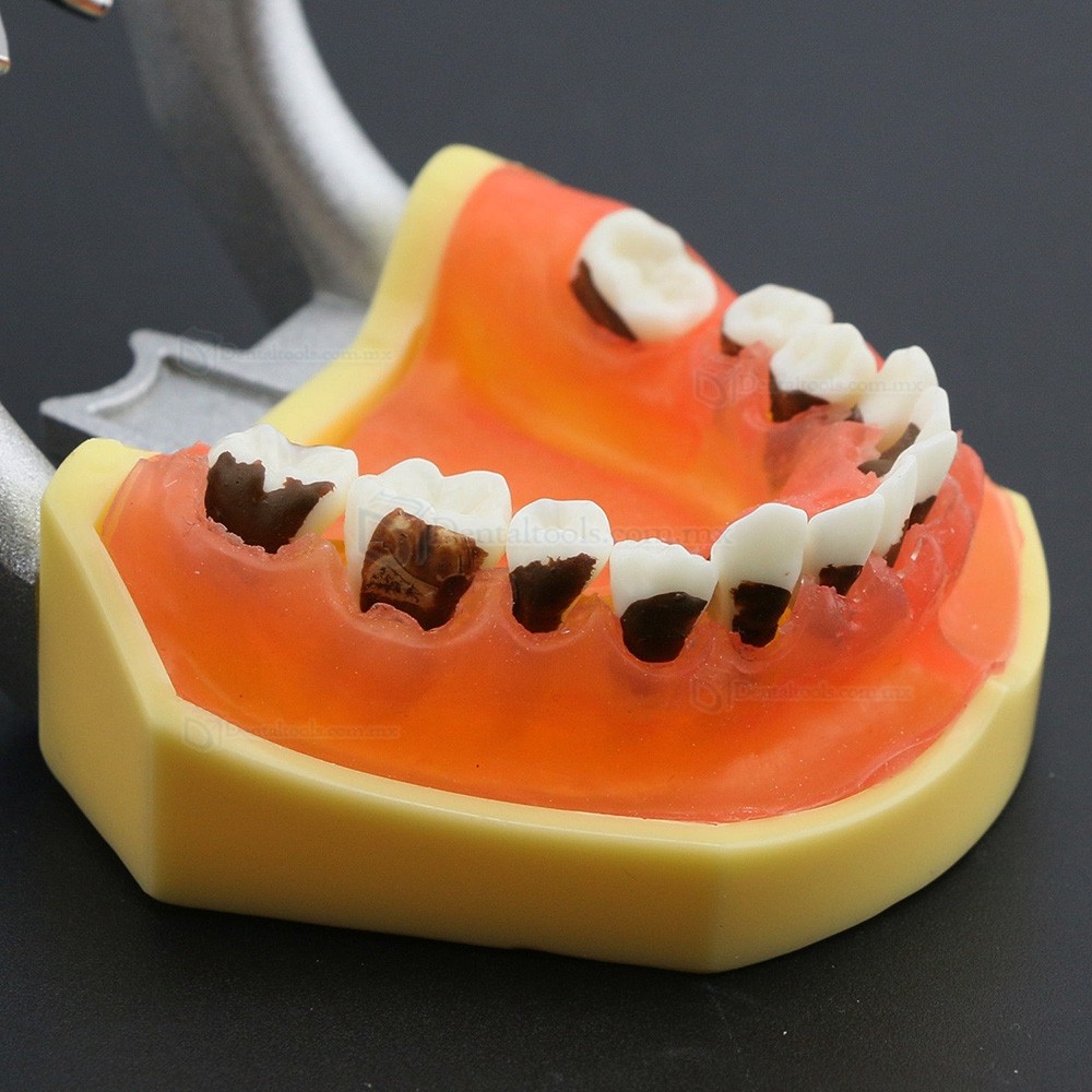 Modelo dental de enfermedad periodontal con enc&iacute;as inflamadas y c&aacute;lculo dental 4003