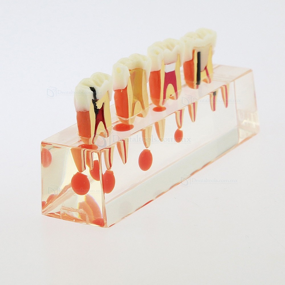 Modelo did&aacute;ctico de endodoncia con 4 etapas del tratamiento de conductos 4018-01