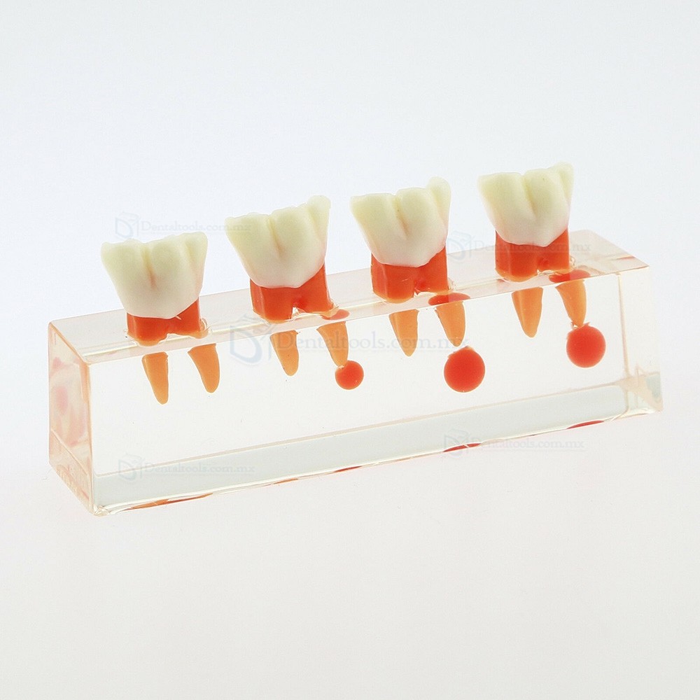 Modelo did&aacute;ctico de endodoncia con 4 etapas del tratamiento de conductos 4018-01