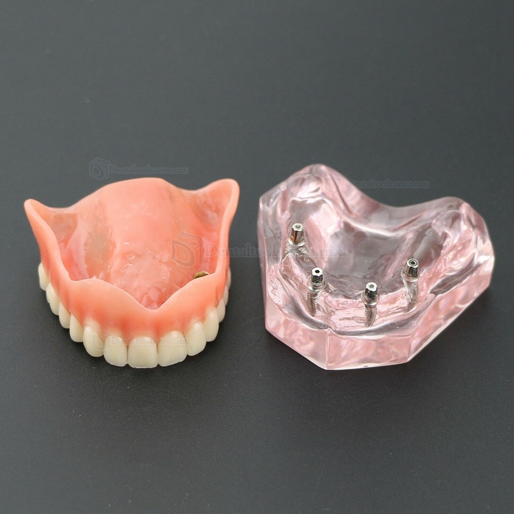 Modelo de Práctica Dental 4 Implantes Demostración Superior Modelo de Sobredentadura Superior 6001 01