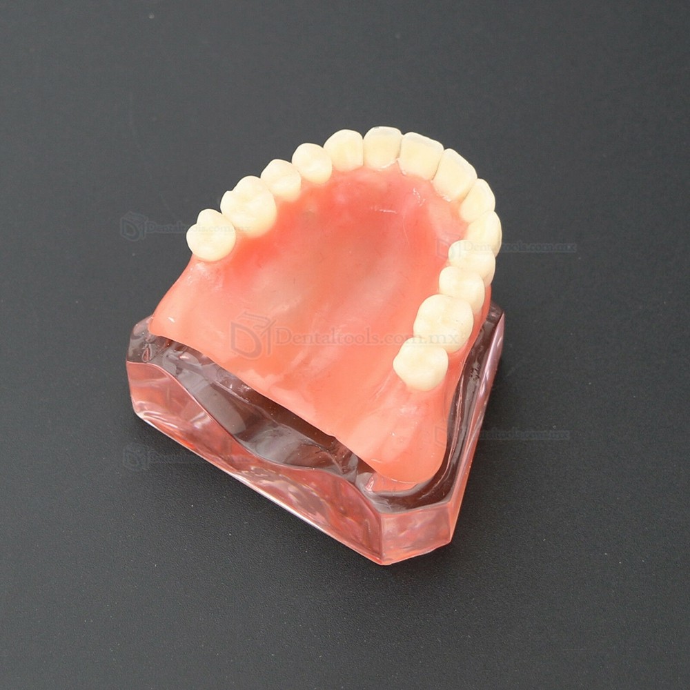 Modelo de Práctica Dental 4 Implantes Demostración Superior Modelo de Sobredentadura Superior 6001 01
