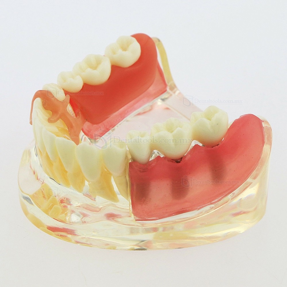 Modelo mandibular de implantes dentales con puente removible para restauración 6006 Modelo mandibular de implantes dentales con puente removible para restauración 6006
