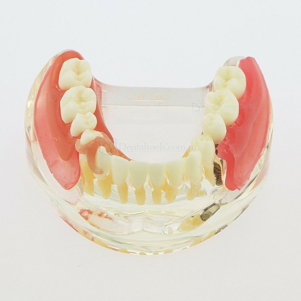 Modelo mandibular de implantes dentales con puente removible para restauración 6006 Modelo mandibular de implantes dentales con puente removible para restauración 6006