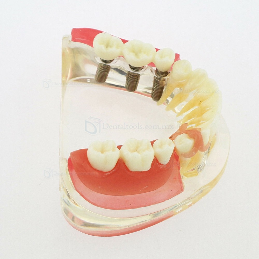 Modelo mandibular de implantes dentales con puente removible para restauración 6006 Modelo mandibular de implantes dentales con puente removible para restauración 6006