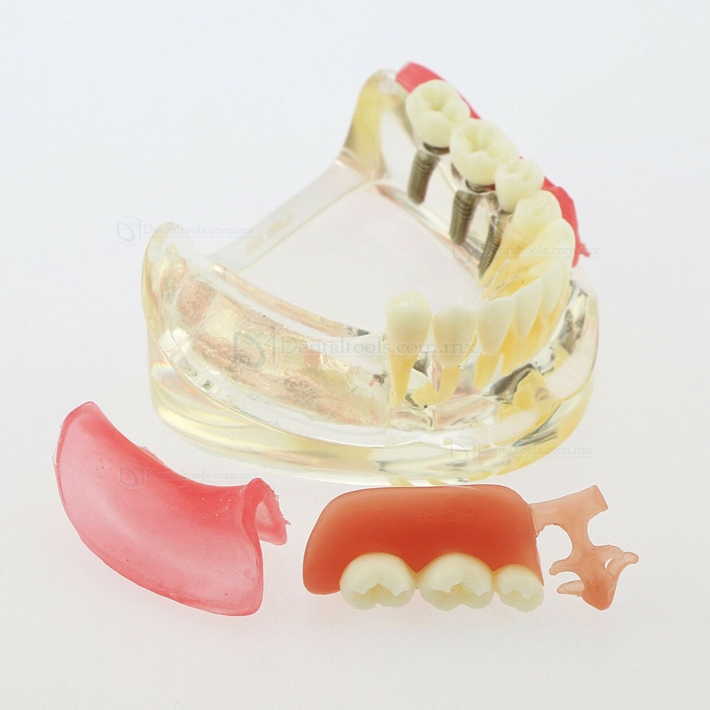 Modelo mandibular de implantes dentales con puente removible para restauración 6006 Modelo mandibular de implantes dentales con puente removible para restauración 6006