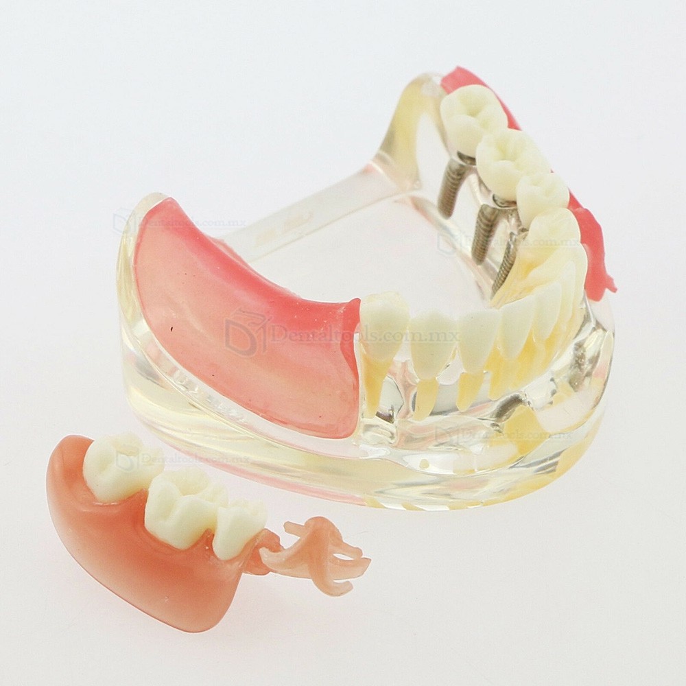 Modelo mandibular de implantes dentales con puente removible para restauración 6006 Modelo mandibular de implantes dentales con puente removible para restauración 6006