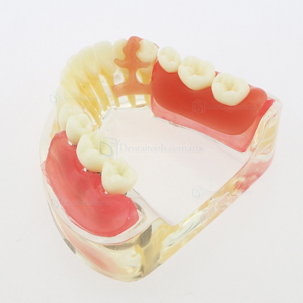 Modelo mandibular de implantes dentales con puente removible para restauración 6006 Modelo mandibular de implantes dentales con puente removible para restauración 6006