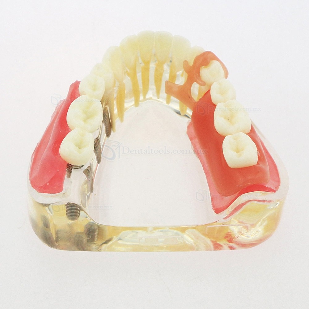Modelo mandibular de implantes dentales con puente removible para restauración 6006 Modelo mandibular de implantes dentales con puente removible para restauración 6006