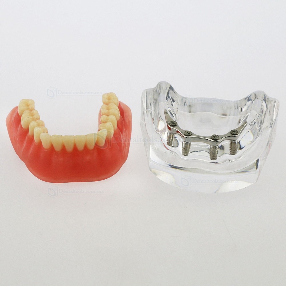 Modelo dental de mandíbula con 4 implantes para demostración 6008 Modelo dental de mandíbula con 4 implantes para demostración 6008