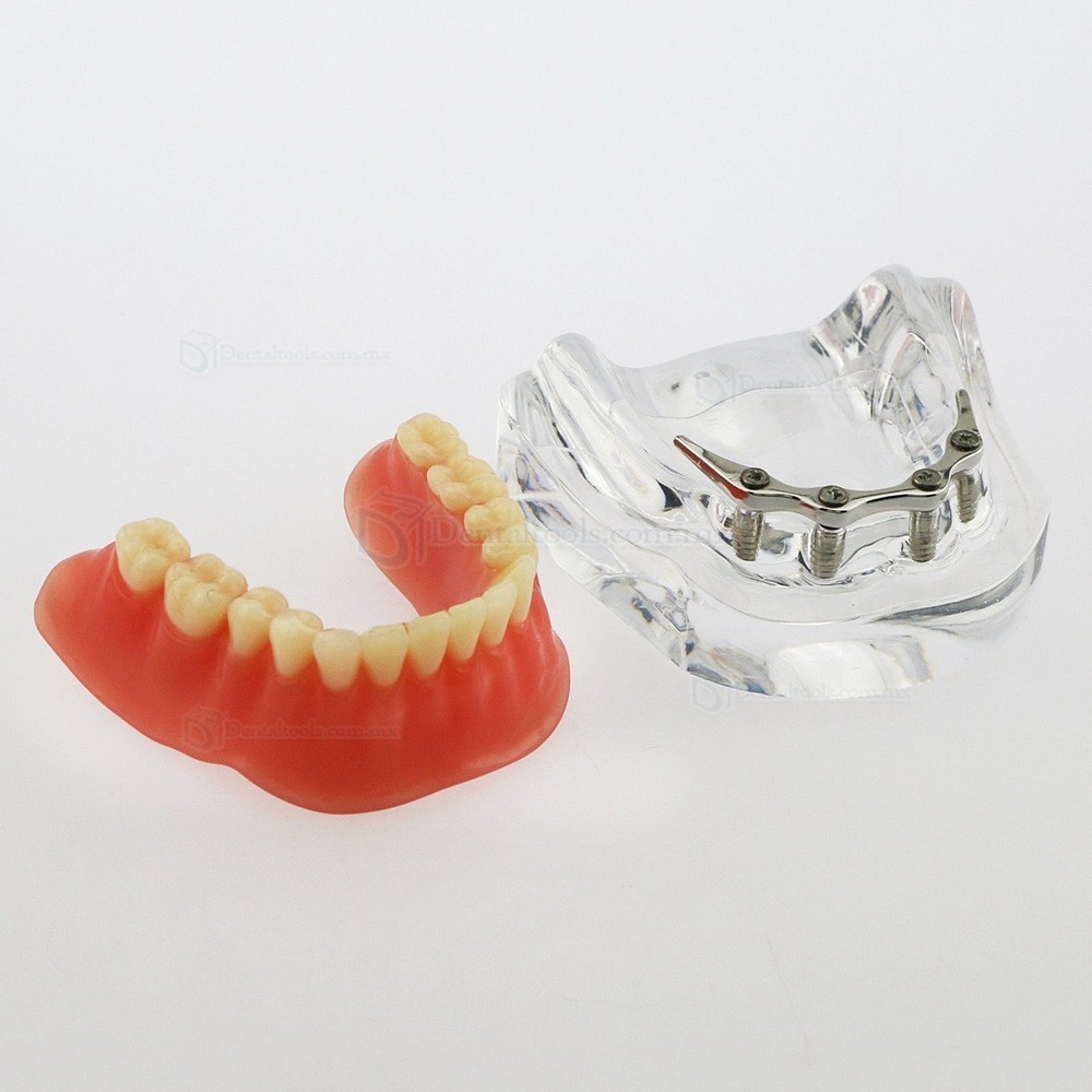 Modelo dental de mandíbula con 4 implantes para demostración 6008 Modelo dental de mandíbula con 4 implantes para demostración 6008