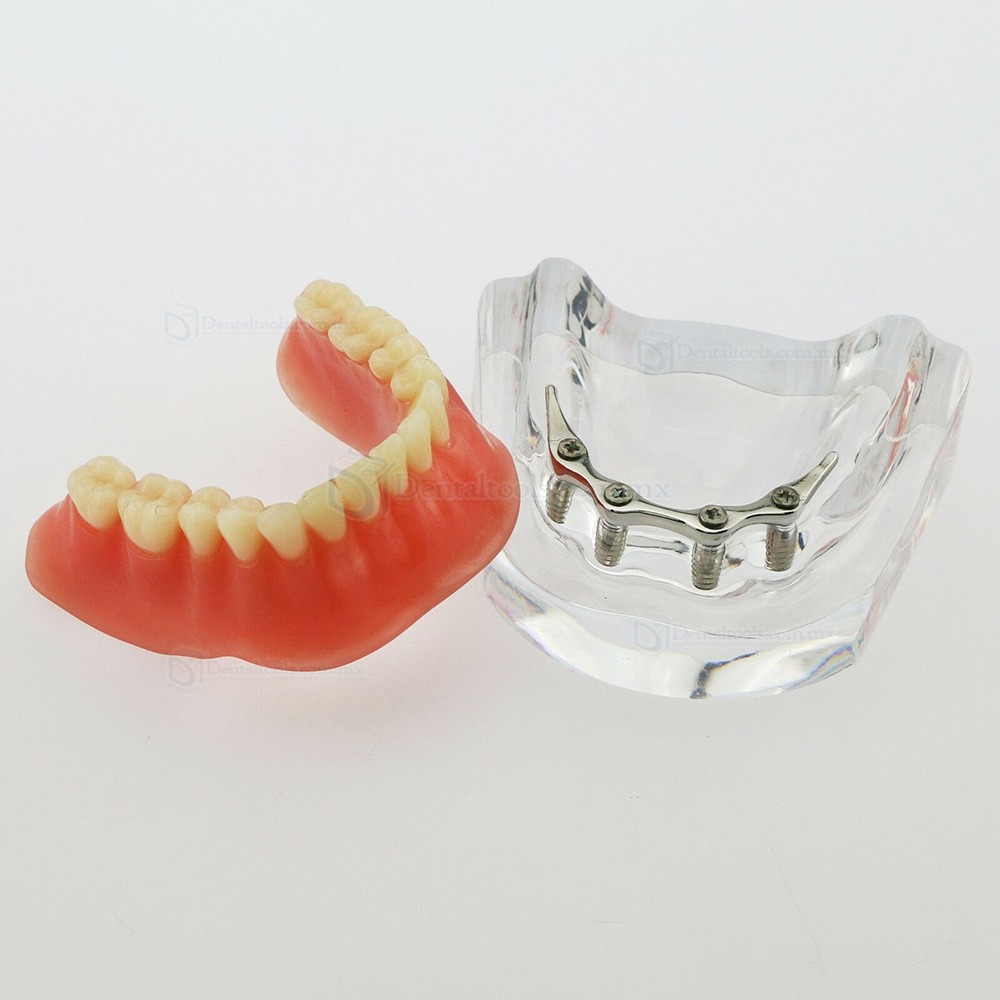 Modelo dental de mandíbula con 4 implantes para demostración 6008 Modelo dental de mandíbula con 4 implantes para demostración 6008
