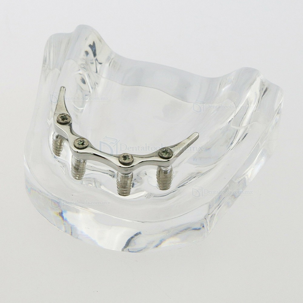Modelo dental de mandíbula con 4 implantes para demostración 6008 Modelo dental de mandíbula con 4 implantes para demostración 6008