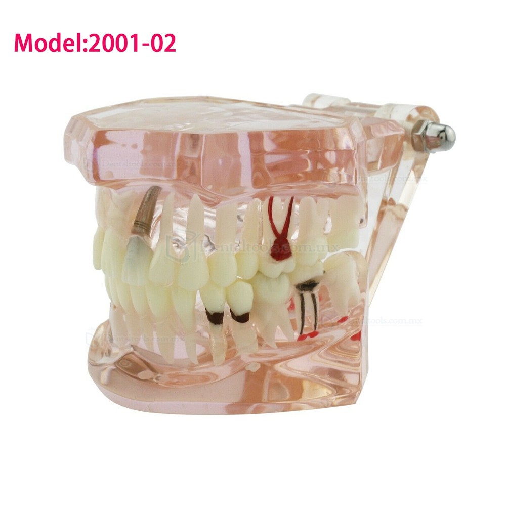 Modelo dental didáctico para demostración de implantes caries y enfermedad periodontal Modelo dental didáctico para demostración de implantes caries y enfermedad periodontal