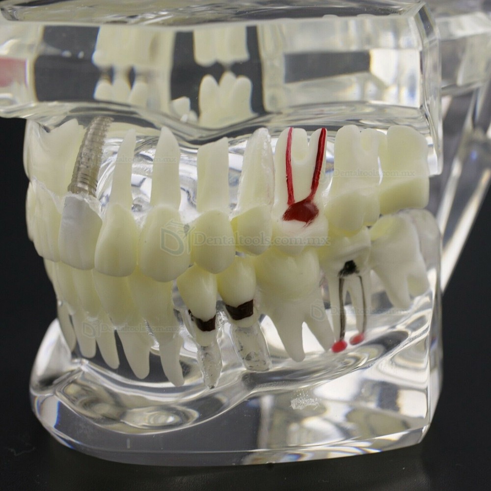 Modelo dental didáctico para demostración de implantes caries y enfermedad periodontal Modelo dental didáctico para demostración de implantes caries y enfermedad periodontal