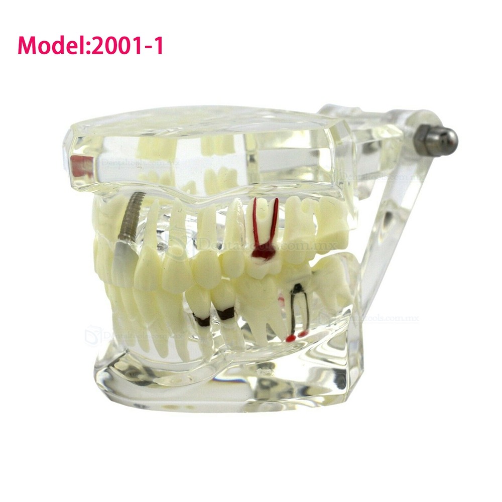 Modelo dental didáctico para demostración de implantes caries y enfermedad periodontal Modelo dental didáctico para demostración de implantes caries y enfermedad periodontal