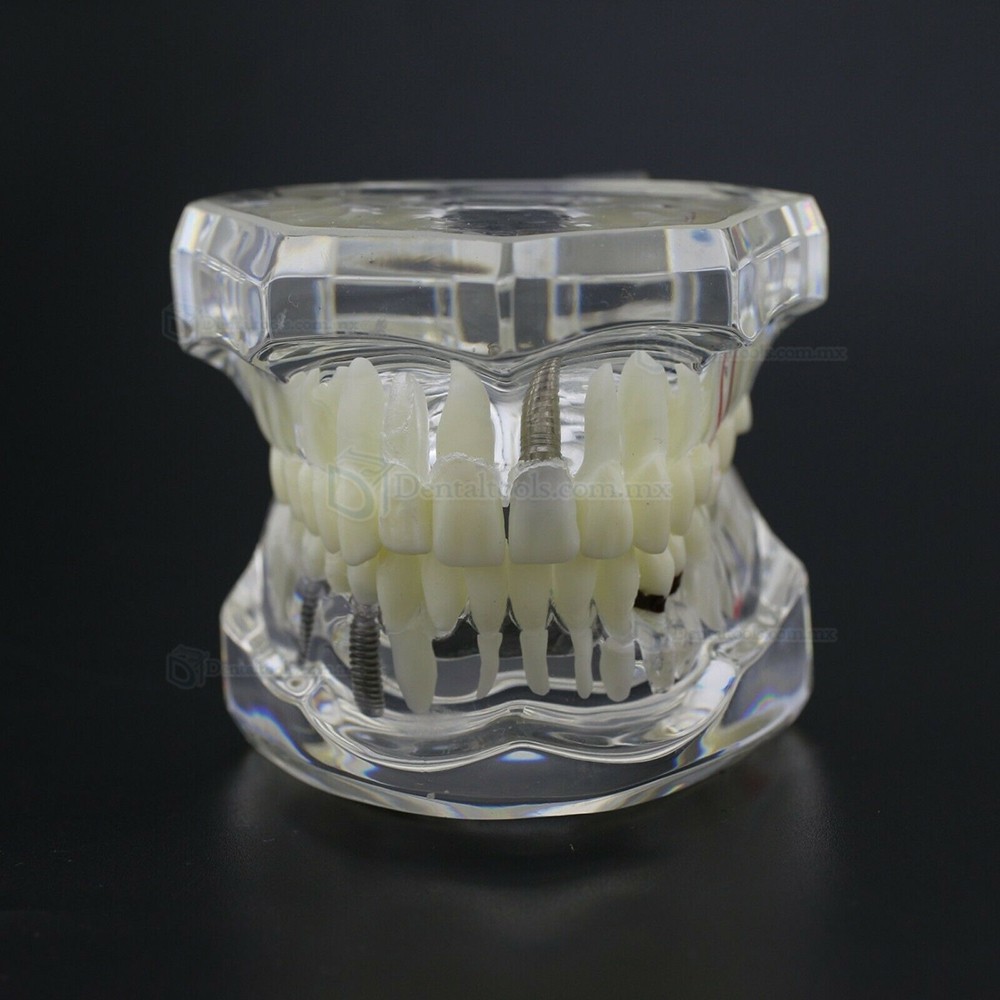 Modelo dental didáctico para demostración de implantes caries y enfermedad periodontal Modelo dental didáctico para demostración de implantes caries y enfermedad periodontal