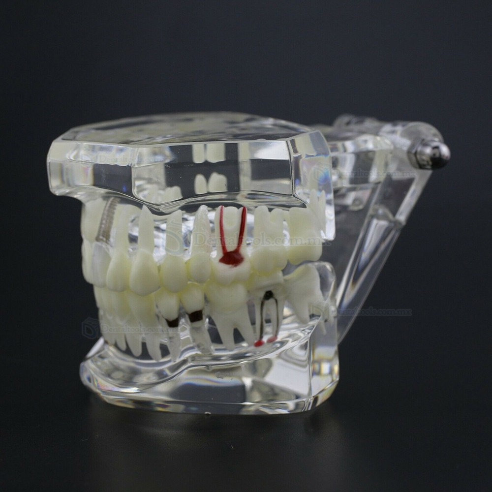 Modelo dental didáctico para demostración de implantes caries y enfermedad periodontal Modelo dental didáctico para demostración de implantes caries y enfermedad periodontal