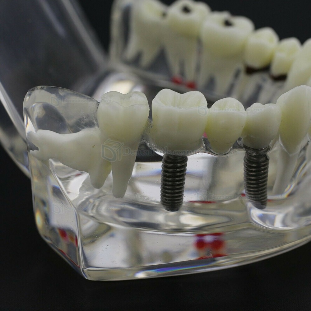 Modelo dental didáctico para demostración de implantes caries y enfermedad periodontal Modelo dental didáctico para demostración de implantes caries y enfermedad periodontal