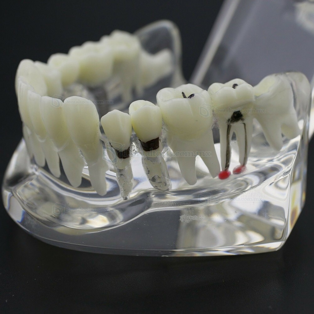 Modelo dental didáctico para demostración de implantes caries y enfermedad periodontal Modelo dental didáctico para demostración de implantes caries y enfermedad periodontal