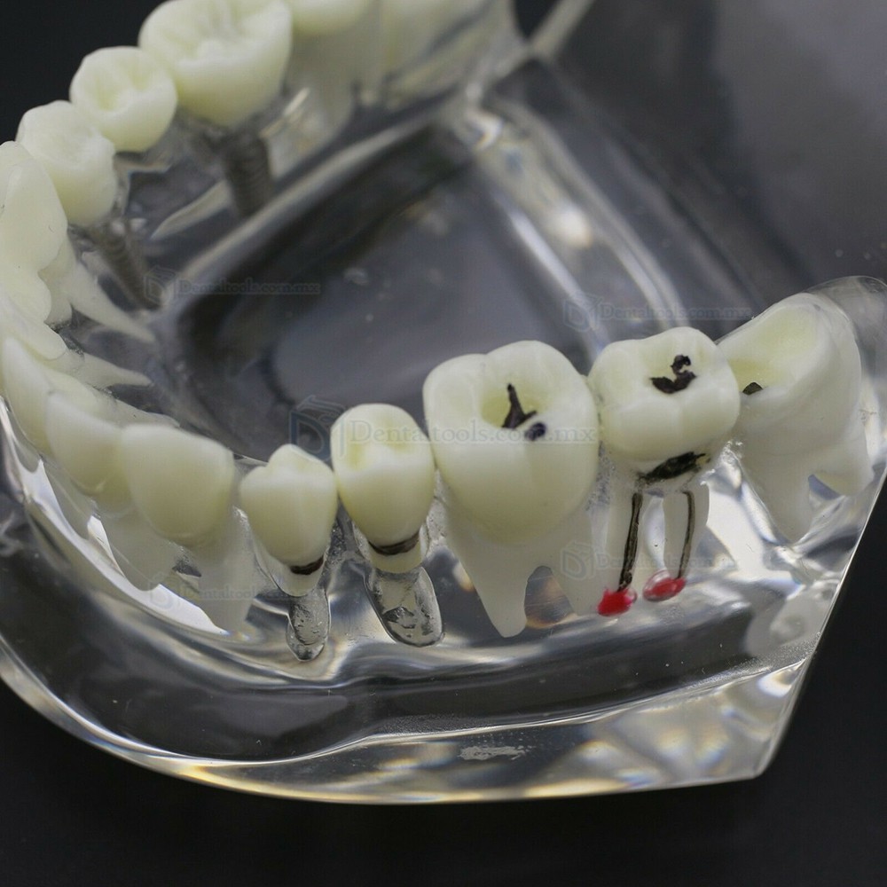 Modelo dental didáctico para demostración de implantes caries y enfermedad periodontal Modelo dental didáctico para demostración de implantes caries y enfermedad periodontal