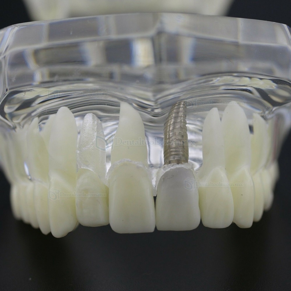 Modelo dental didáctico para demostración de implantes caries y enfermedad periodontal Modelo dental didáctico para demostración de implantes caries y enfermedad periodontal