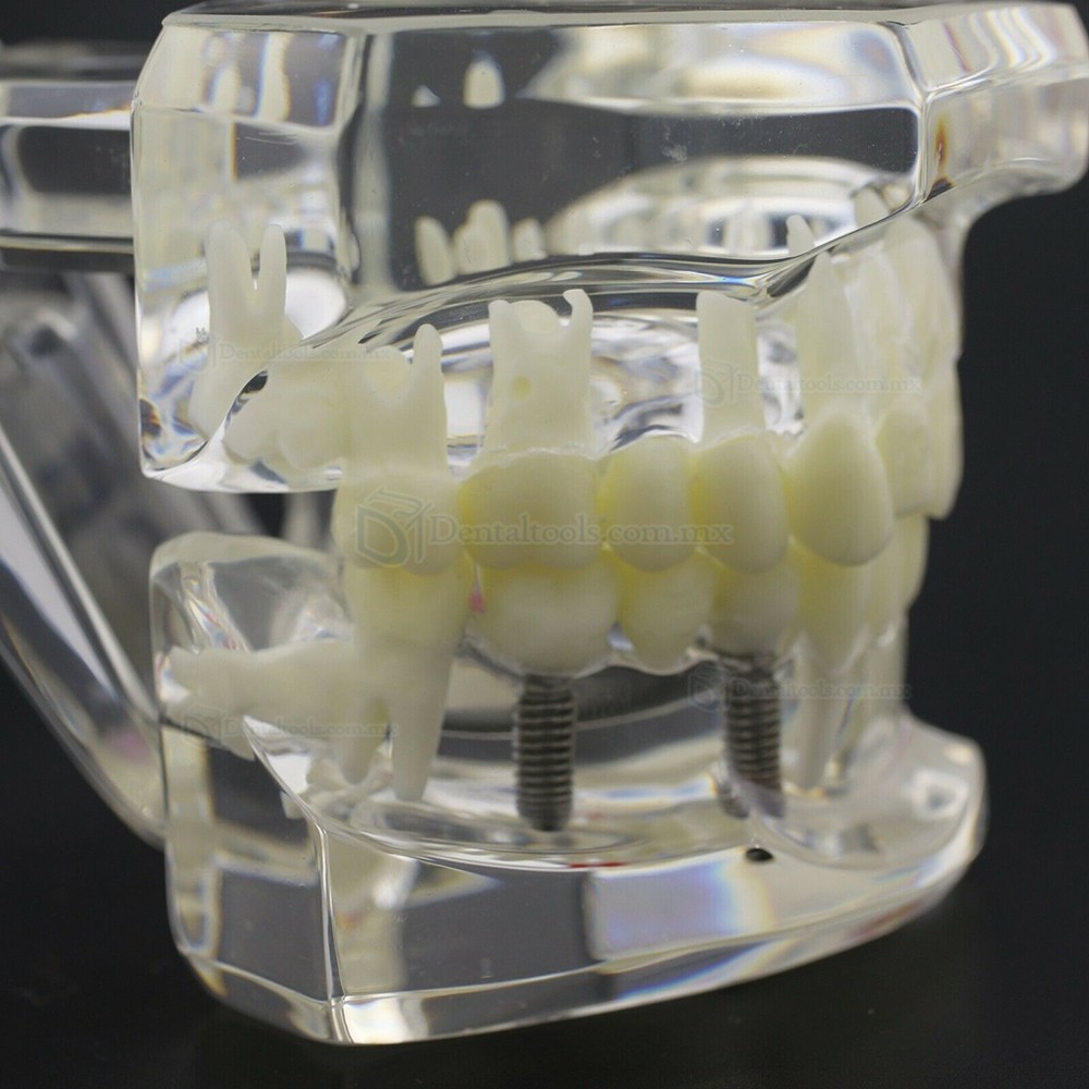 Modelo dental didáctico para demostración de implantes caries y enfermedad periodontal Modelo dental didáctico para demostración de implantes caries y enfermedad periodontal