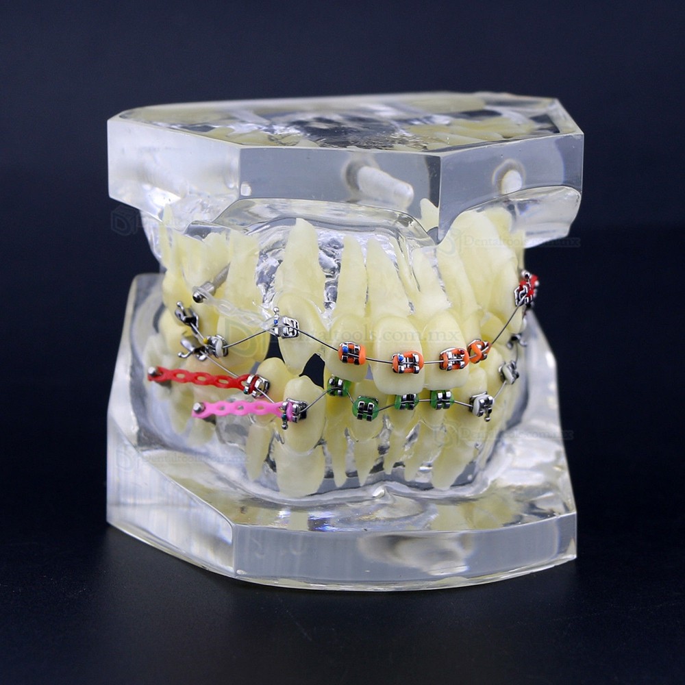 Modelo de tratamiento de ortodoncia con brackets metálicos arcos ligaduras y cadena elástica Modelo de tratamiento de ortodoncia con brackets metálicos arcos ligaduras y cadena elástica