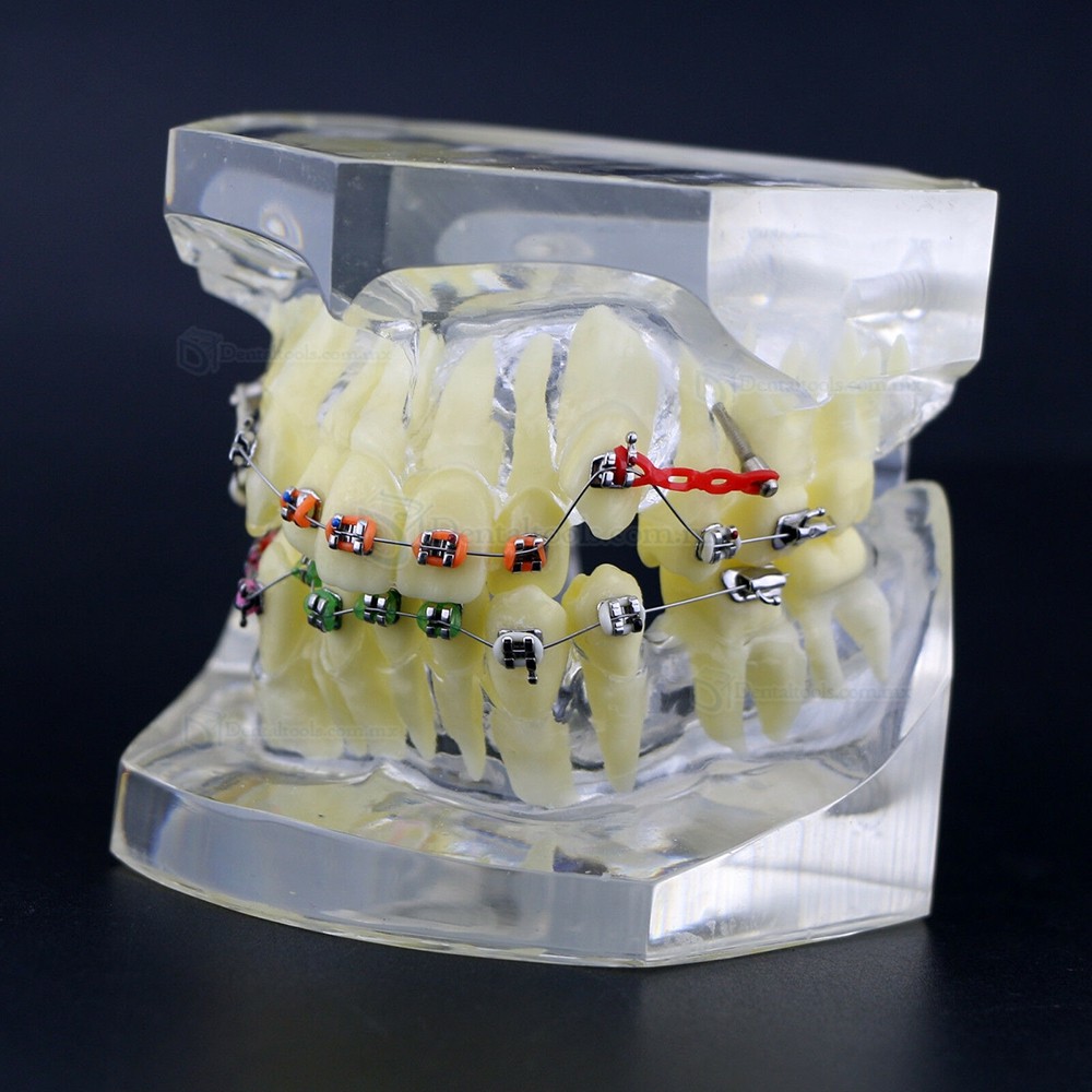 Modelo de tratamiento de ortodoncia con brackets metálicos arcos ligaduras y cadena elástica Modelo de tratamiento de ortodoncia con brackets metálicos arcos ligaduras y cadena elástica