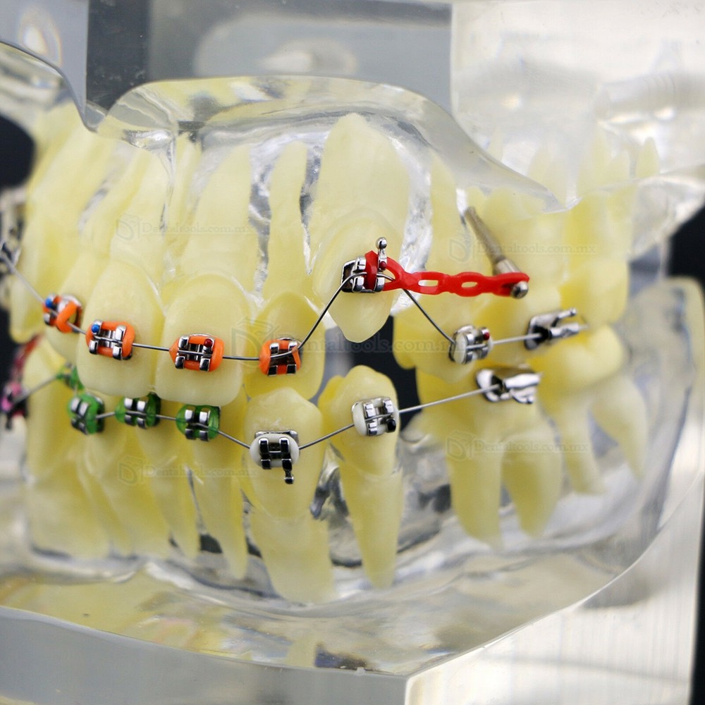 Modelo de tratamiento de ortodoncia con brackets metálicos arcos ligaduras y cadena elástica Modelo de tratamiento de ortodoncia con brackets metálicos arcos ligaduras y cadena elástica