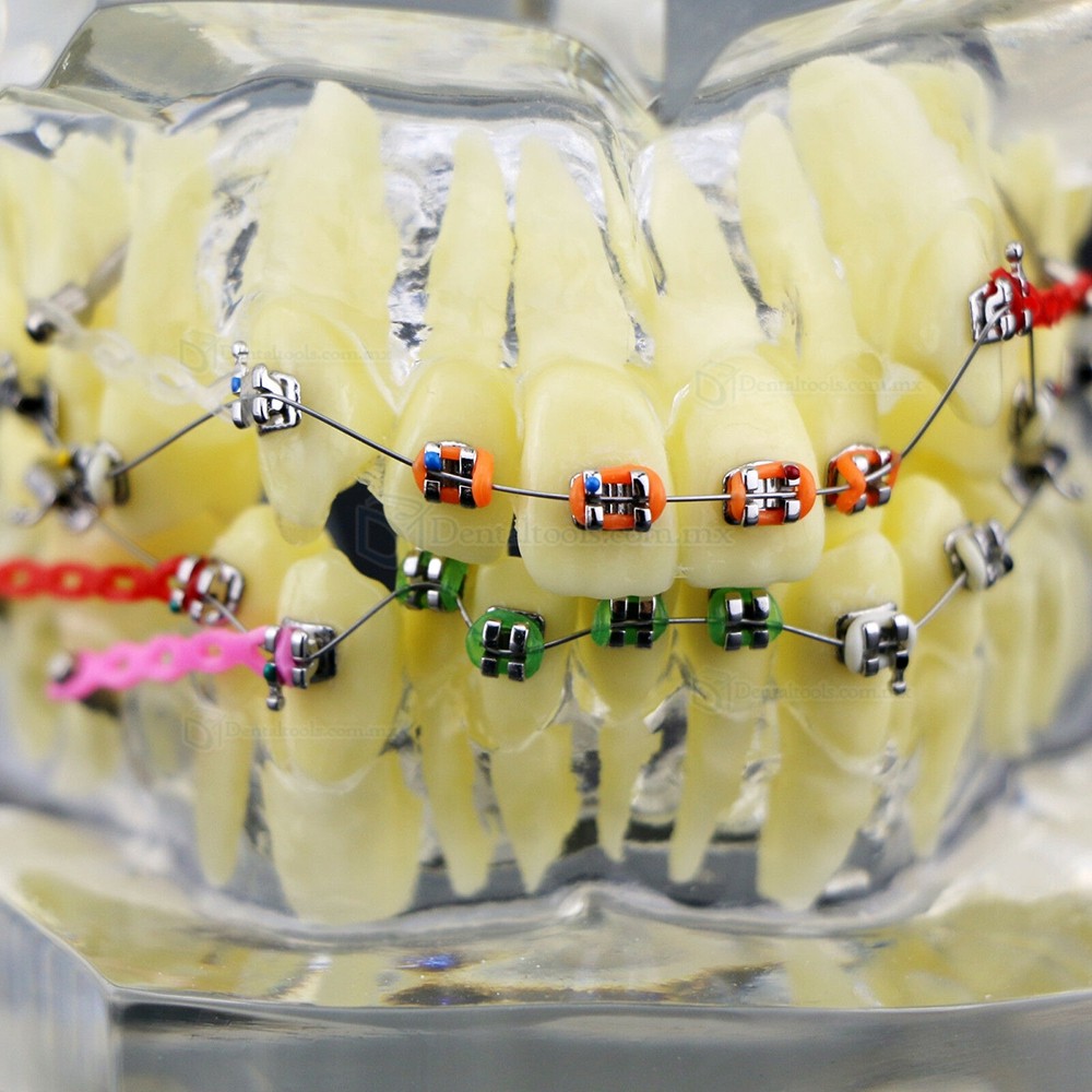 Modelo de tratamiento de ortodoncia con brackets metálicos arcos ligaduras y cadena elástica Modelo de tratamiento de ortodoncia con brackets metálicos arcos ligaduras y cadena elástica