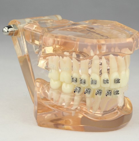 Modelo de ortodoncia con brackets cerámicos para demostración M3009 Modelo de ortodoncia con brackets cerámicos para demostración M3009