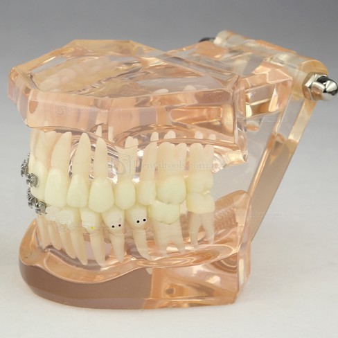 Modelo de ortodoncia con brackets cerámicos para demostración M3009 Modelo de ortodoncia con brackets cerámicos para demostración M3009