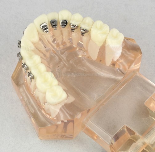 Modelo de ortodoncia con brackets cerámicos para demostración M3009 Modelo de ortodoncia con brackets cerámicos para demostración M3009