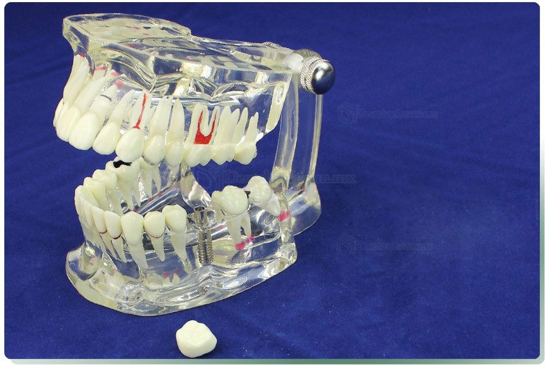 ENOVO Modelo de restauración del implante & Demostración de enfermedad Dental