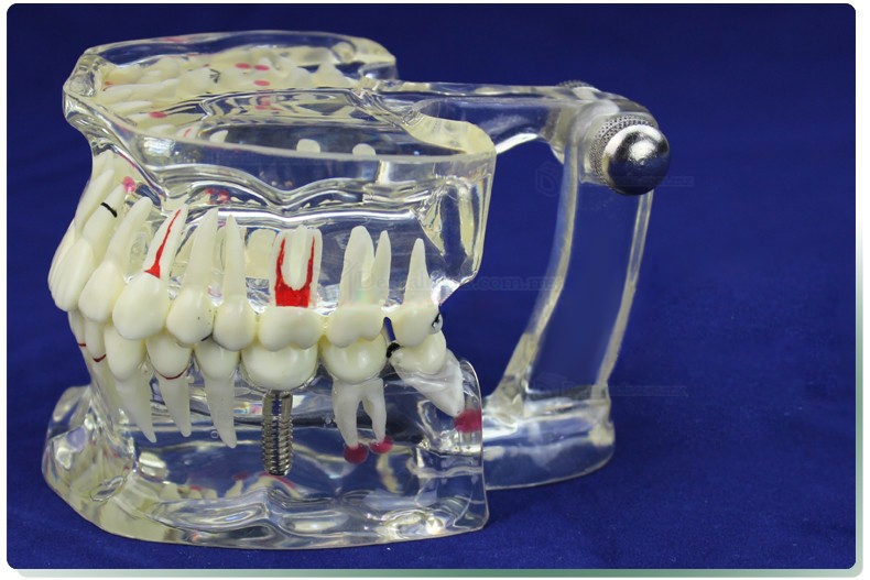 ENOVO Modelo de restauración del implante & Demostración de enfermedad Dental