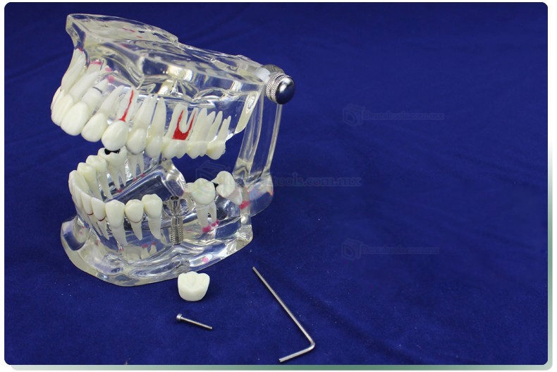 ENOVO Modelo de restauración del implante & Demostración de enfermedad Dental