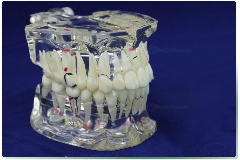 ENOVO Modelo de restauración del implante & Demostración de enfermedad Dental