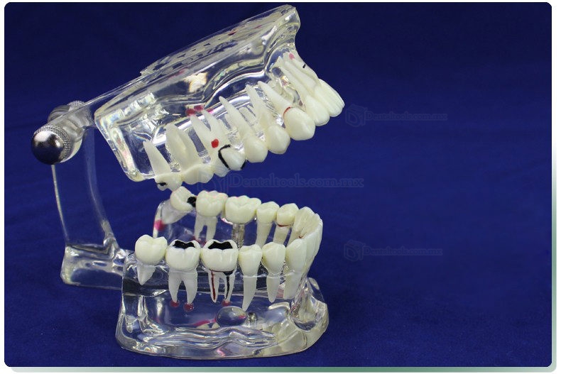 ENOVO Modelo de restauración del implante & Demostración de enfermedad Dental