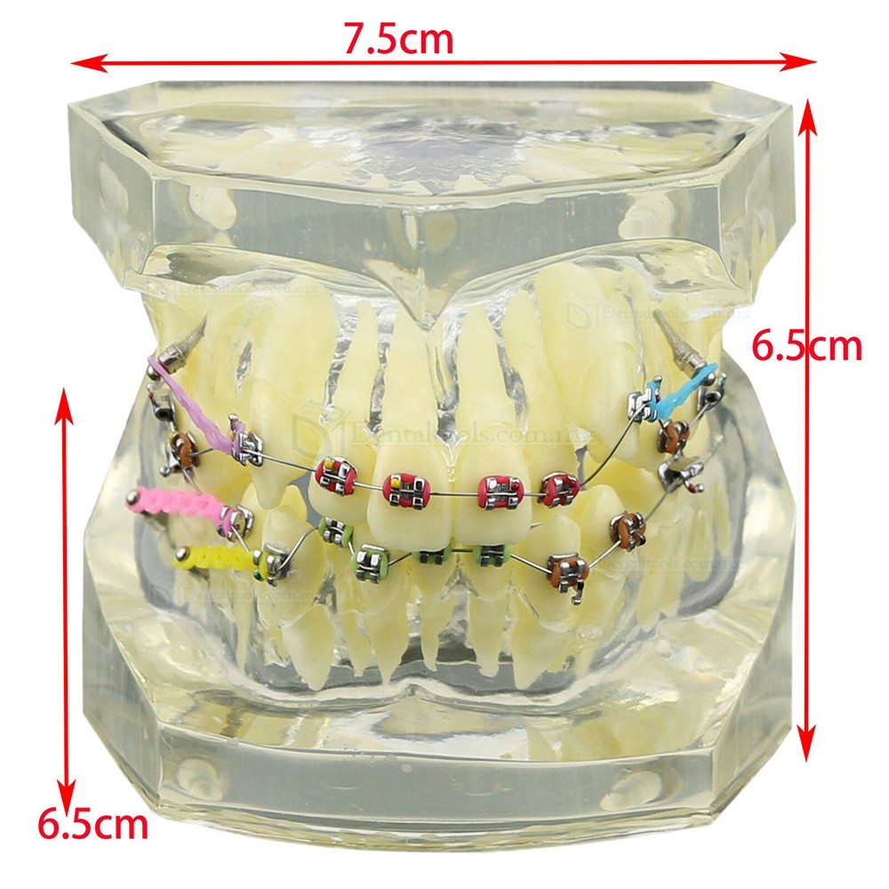 Modelo de ortodoncia con brackets metálicos cerámicos y autoligables con tubos y cadena elástica Modelo de ortodoncia con brackets metálicos cerámicos y autoligables con tubos y cadena elástica