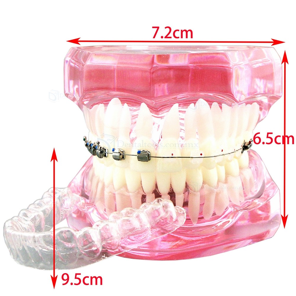 Modelo de ortodoncia con brackets metálicos cerámicos y autoligables con tubos y cadena elástica Modelo de ortodoncia con brackets metálicos cerámicos y autoligables con tubos y cadena elástica