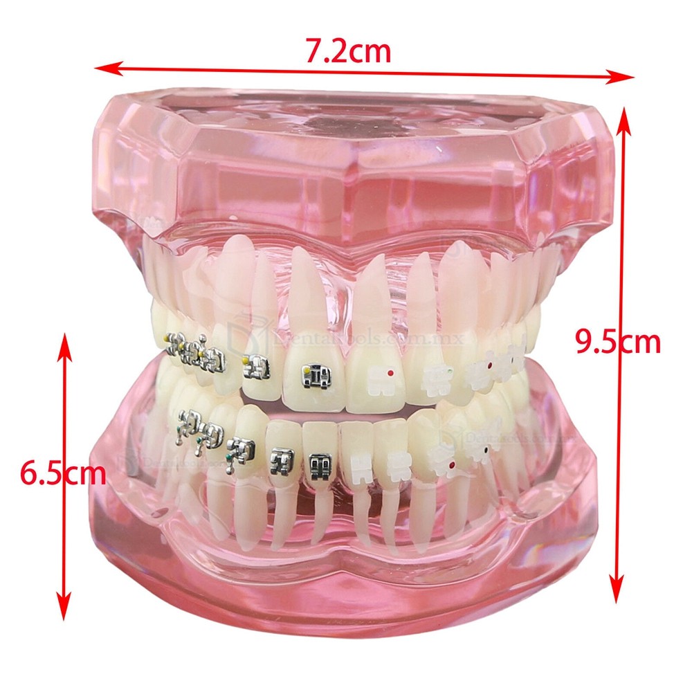 Modelo de ortodoncia con brackets metálicos cerámicos y autoligables con tubos y cadena elástica Modelo de ortodoncia con brackets metálicos cerámicos y autoligables con tubos y cadena elástica