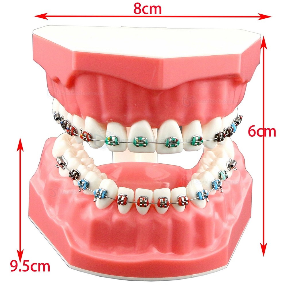 Modelo de ortodoncia con brackets metálicos cerámicos y autoligables con tubos y cadena elástica Modelo de ortodoncia con brackets metálicos cerámicos y autoligables con tubos y cadena elástica