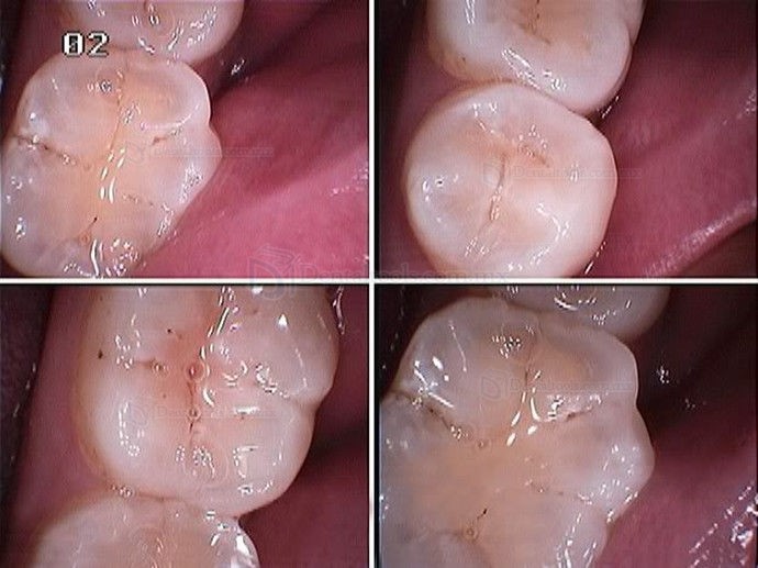 Cámara intraoral dental de 4MP con sensor CCD Sony y conexión USB Cámara intraoral dental de 4MP con sensor CCD Sony y conexión USB