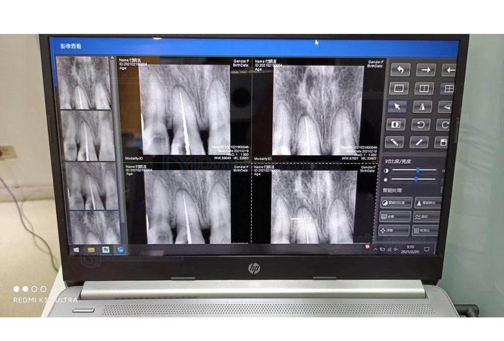 Alta calidad Sensor Digital de Rayos X Dental Sensor Radiográfico