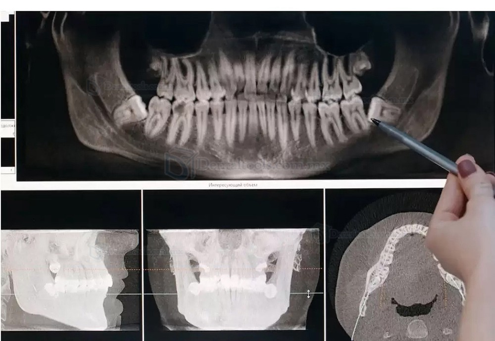 Refine MaxSurgery Unidad de piezocirugía dental Sistema de cirugía ósea piezoeléctrica ultrasónica