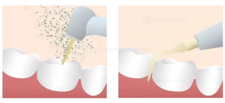 Refine MaxSurgery Unidad de piezocirugía dental Sistema de cirugía ósea piezoeléctrica ultrasónica