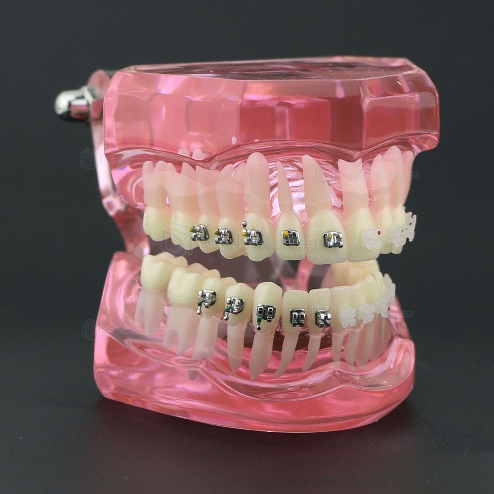 Modelo de ortodoncia con brackets metálicos y cerámicos para enseñanza 3003 Modelo de ortodoncia con brackets metálicos y cerámicos para enseñanza 3003