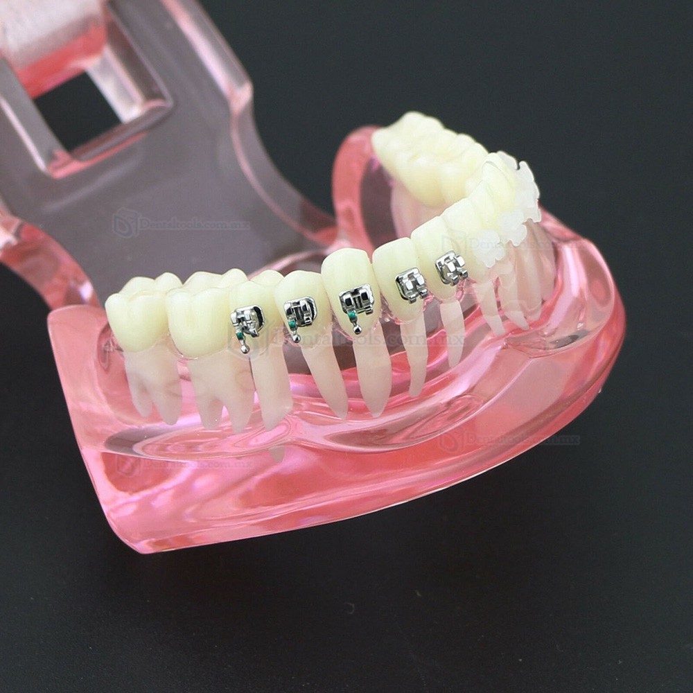 Modelo de ortodoncia con brackets metálicos y cerámicos para enseñanza 3003 Modelo de ortodoncia con brackets metálicos y cerámicos para enseñanza 3003
